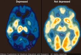 Image shows the dramatic brightness of a brain lit up by ketamine wannabe drug treatment, and the darkness in the depressed brain without it.